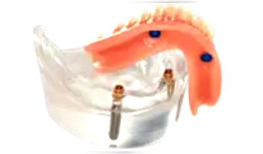 dental implant