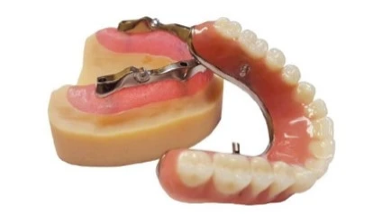 dental implant