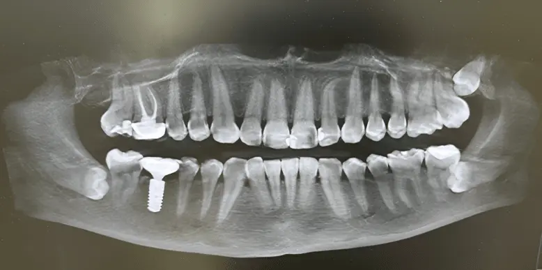 Wisdom teeth or tooth removal