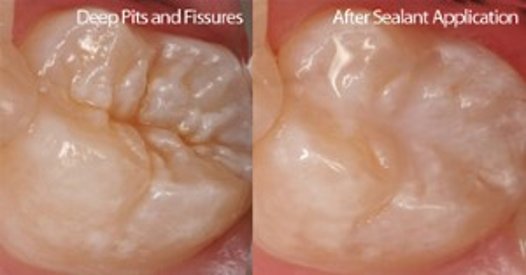 Dental Sealants