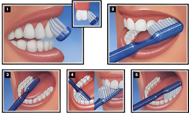 Pit and Fissure Sealants