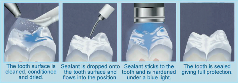 Pit and Fissure Sealants