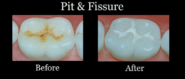 Pit and Fissure Sealants