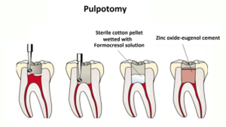 Pulpotomy