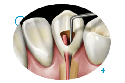 root-canal-endodontics