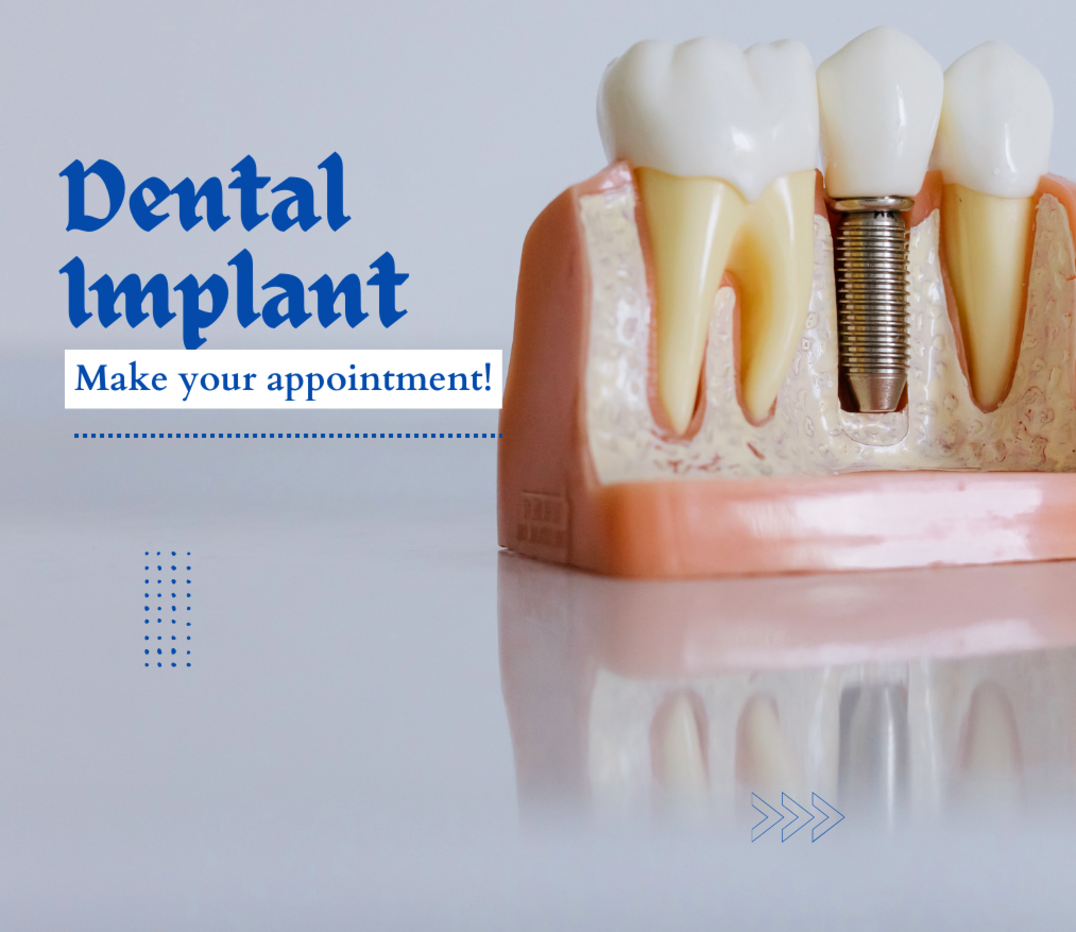 Dental Implants