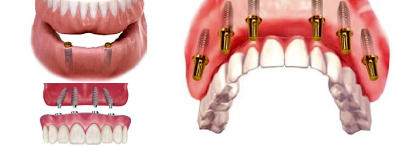 Full Mouth Rehabilitation