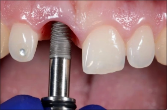 Surgical Placement of a Dental Implant