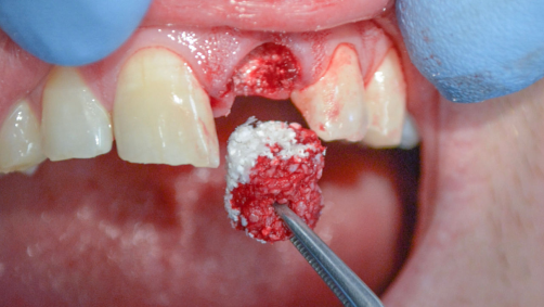 Bone Grafting Surgery