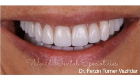 Dental Implants Case Study 4 Before Image