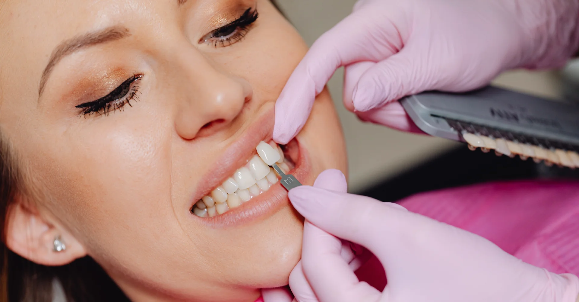 Dental Veneers: A Celebrity Smile Trend — What Dentists Want You to Know