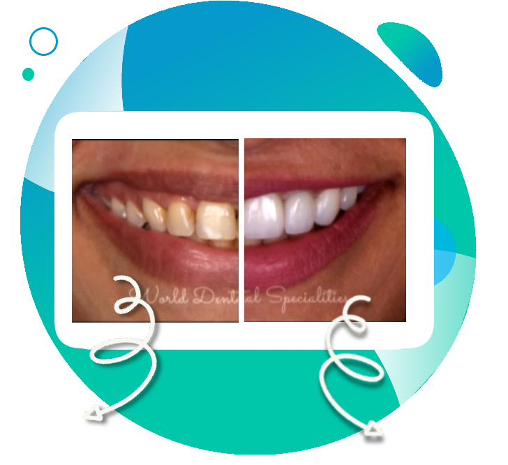 Porcelain Veneers Dentist Mumbai