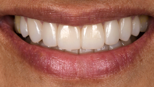 Porcelain Veneers Dentist