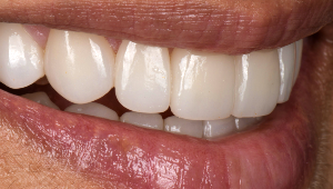 Porcelain Veneers Dentist