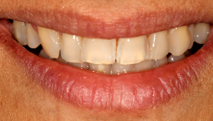 Porcelain Veneers Dentist