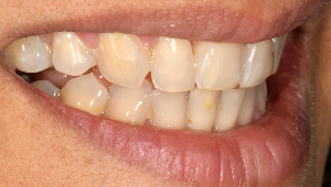 Porcelain Veneers Dentist