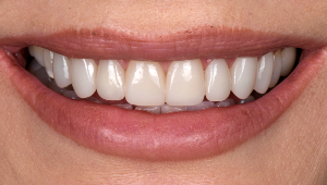 Porcelain Veneers Dentist