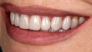 Porcelain Veneers Dentist