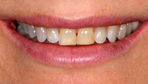 Porcelain Veneers Dentist