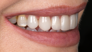 Porcelain Veneers Dentist